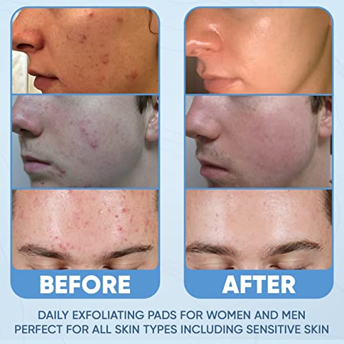 Salicylic Acid Acne Pads Maximum Strength Facial Peel Resurfacing & Exfoliating Radiance Pads Daily Skin Care Treatment Сlean Pores Blackheads Prevention Face Wash Wipes For Teens Women & Men 60 Count