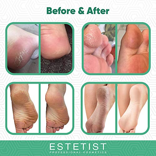 Tea Tree Oil Foot Cream for Dry Cracked Skin, Heel and Calluses, Athletes Foot - Helps with Scaly, Jock Itch and Itchy Skin - Foot Treatment Eczema Cream and Skin Moisturizer - Antifungal Foot Cream
