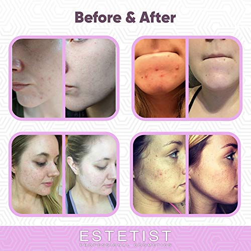 Purifying Pink Face Mask - Blackhead Remover Mask with Australian Pink Clay, Facial Mask Skin Care, Pore Cleaner and Pore Minimizer